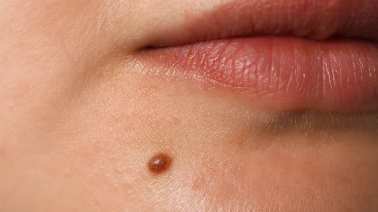 Vitiligo Nedir, Belirtileri ve Tedavisi Nelerdir?