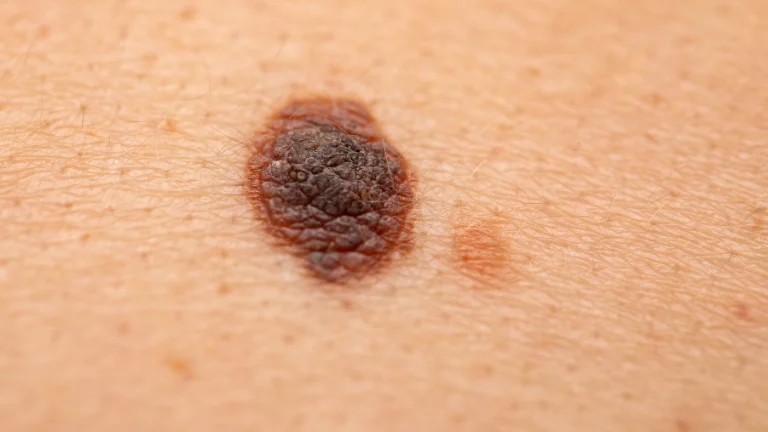 Vitiligo Nedir, Belirtileri ve Tedavisi Nelerdir?